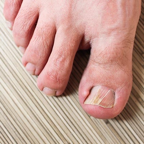 ingrown toenail treatment ingrown toenail treatment