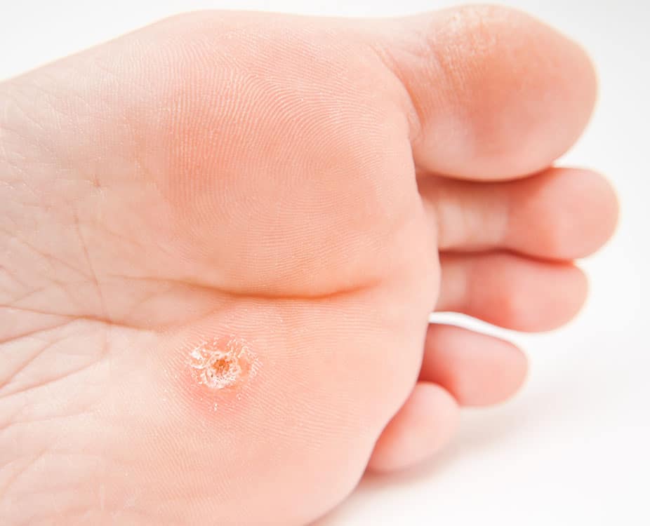 wart on foot wart on foot